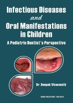 Infectious Diseases and Oral Manifestations in Children: A Pediatric Dentist’s Perspective