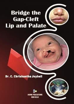 Bridge The Gap-Cleft Lip and Palate