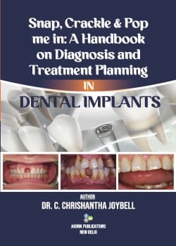 Snap, Crackle & POP me in: A Handbook on Diagnosis and Treatment Planning in Dental Implants