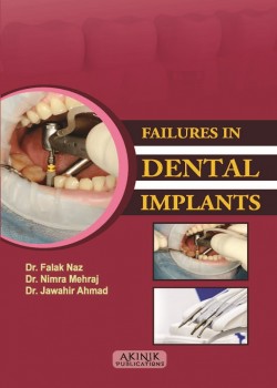 Failures in Dental Implants