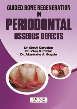 Guided Bone Regeneration in Periodontal Osseous Defects