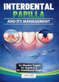 Interdental Papilla and Its Management