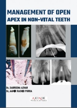Management of Open Apex in Non-Vital Teeth