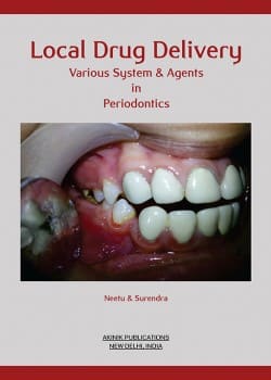 Local Drug Delivery Various System & Agents in Periodontics