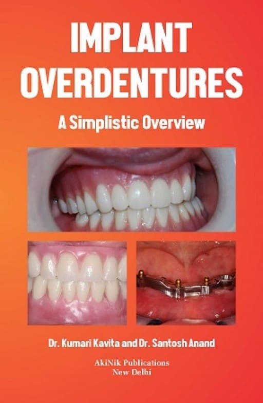 Implant Overdentures: A Simplistic Overview