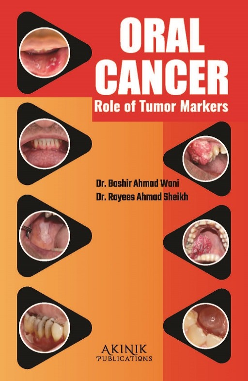 Oral Cancer: Role of Tumor Markers